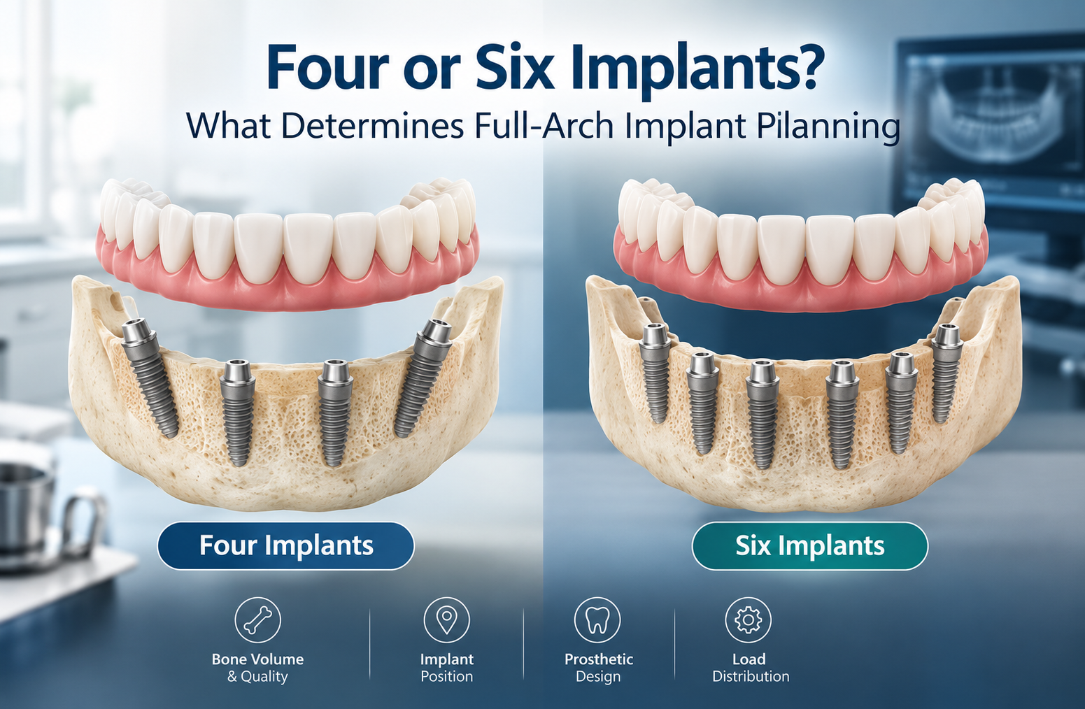 Four or Six Implants? What Determines Full-Arch Implant Planning
